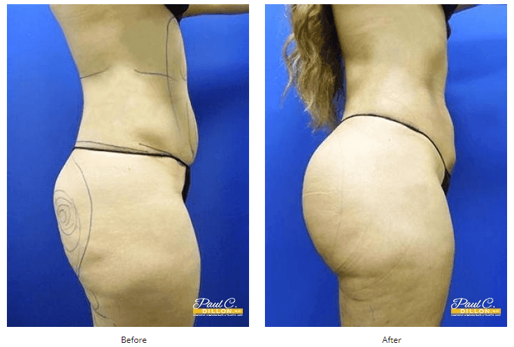 Breast Augmentation Can Restore Curves After Weight Loss - Paul C