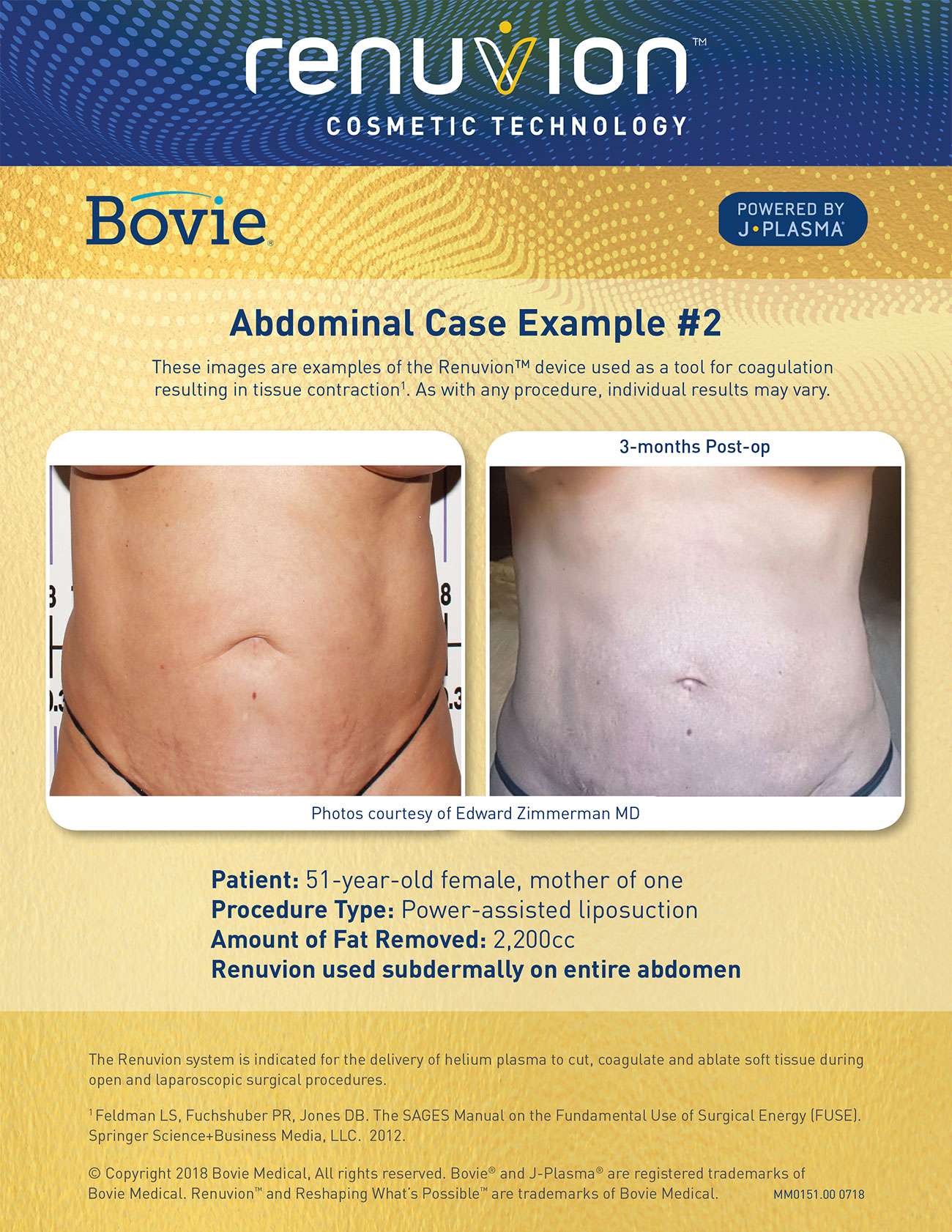 Skin Tightening Abdomen - RejuvaYou Medical