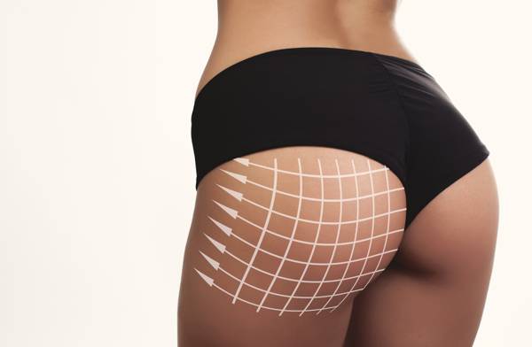 Am I a Good Candidate for a Brazilian Butt Lift? – Aristocrat Plastic  Surgery