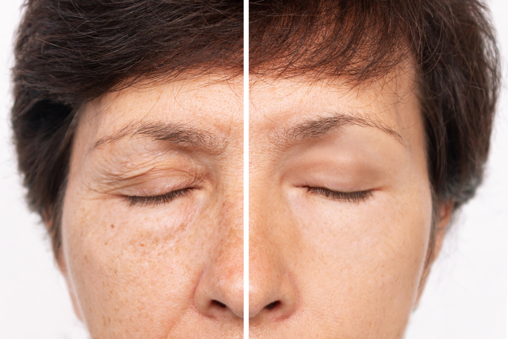 Reduce Bagginess And Excess Skin With An Eyelid Lift