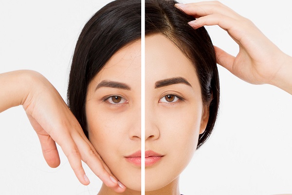 What Is A Forehead Lift?