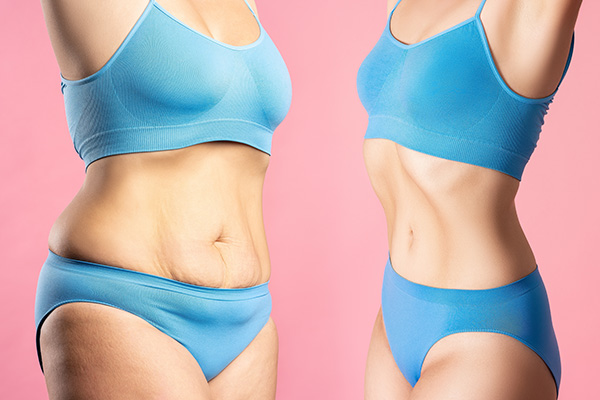 Areas of the Body Liposuction Can Improve