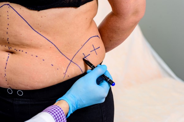 Going For Tummy Tuck Surgery, Consider These Smart Recovery Tips