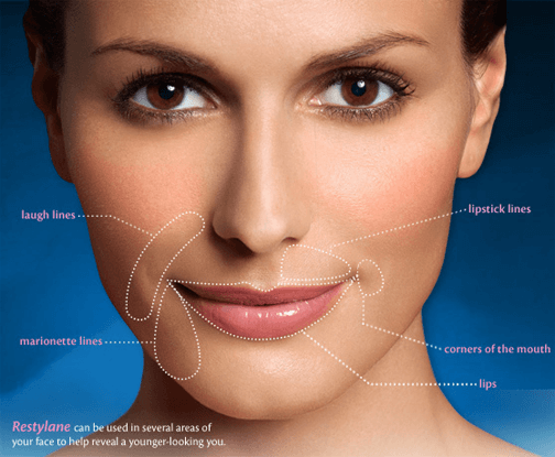 What Are The Benefits Of Restylane Paul C Dillon Md Inc Schaumburg Il 60173 