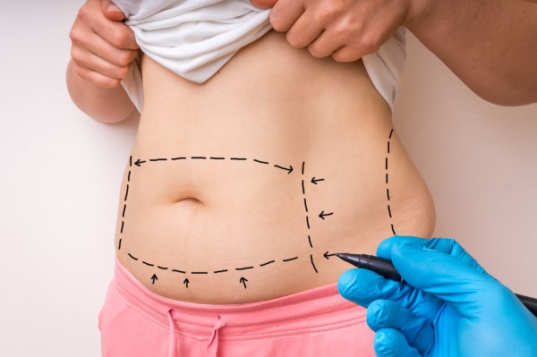A Guide To The Tummy Tuck Procedure